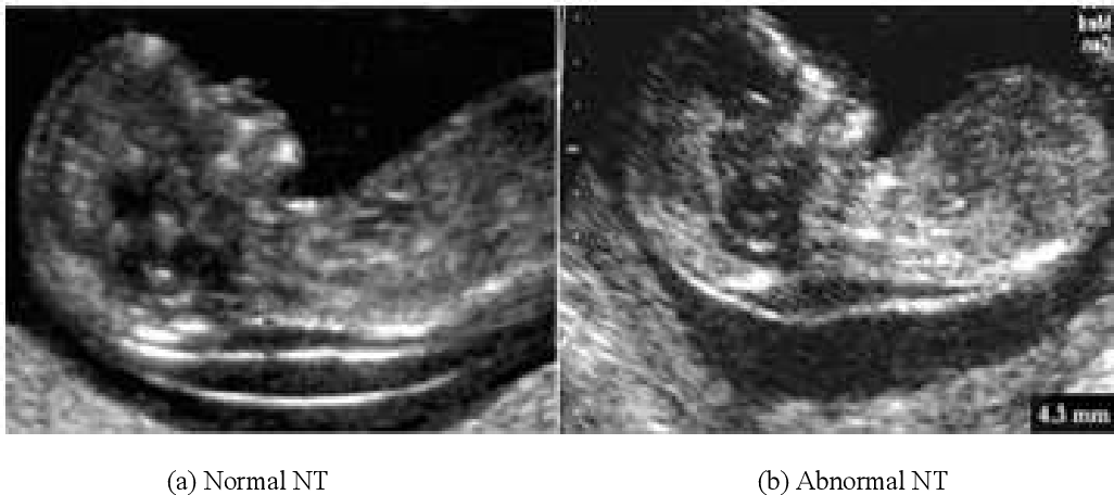 سونوگرافی غربالگری اول| Ultrasound screening first