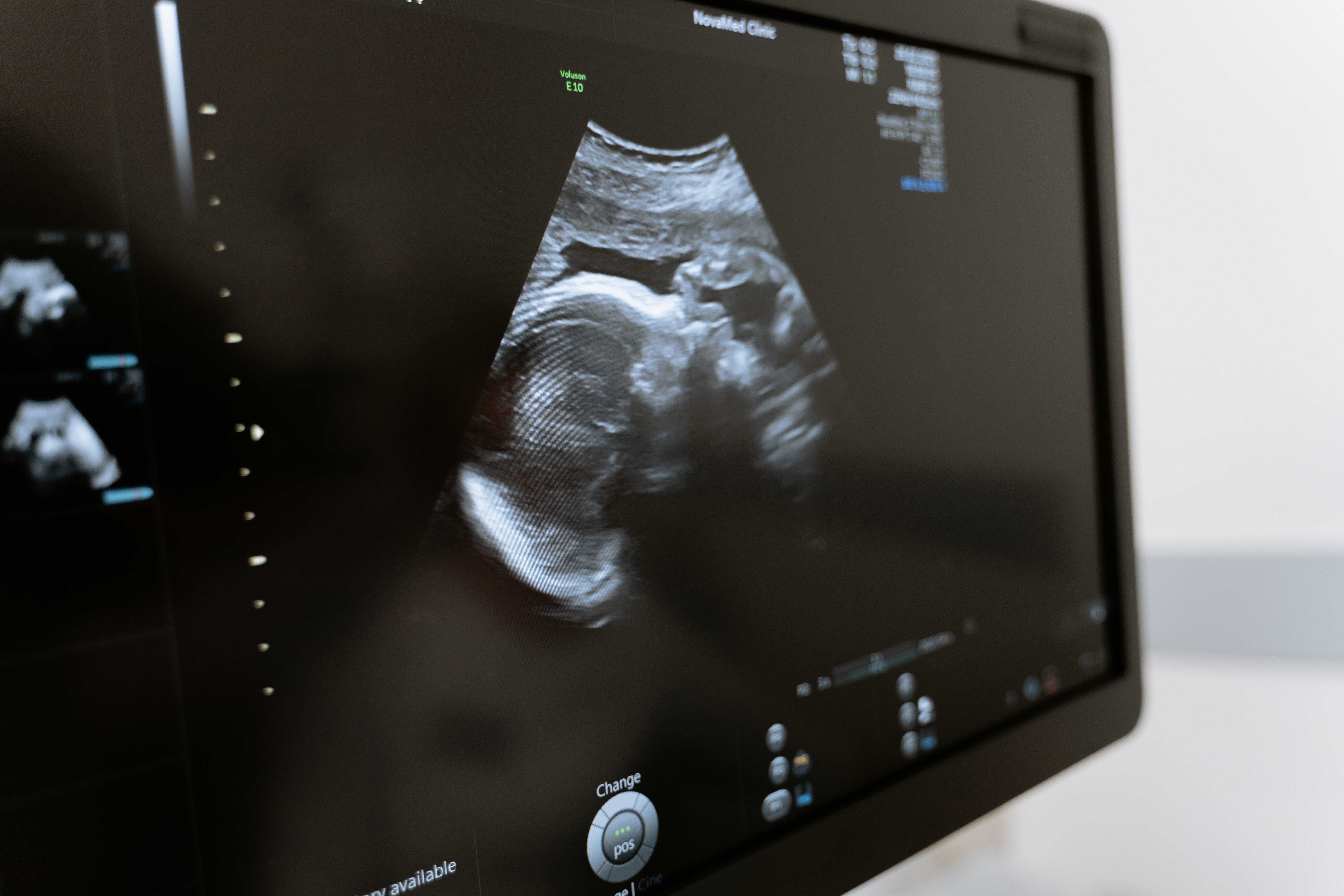 Pregnancy ultrasound/سونوگرافی حاملگی