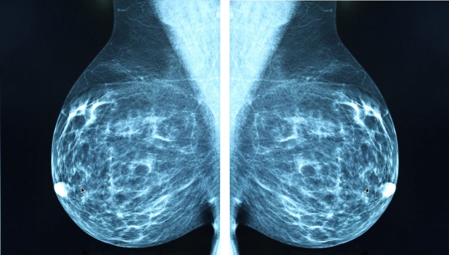 d/سونوگرافی سینه یا پستان