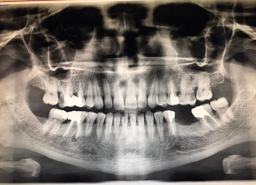 g/عکس دندان