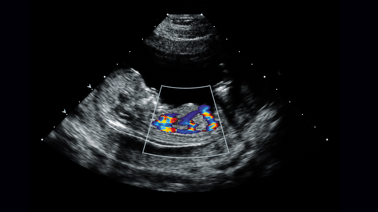 echocardiography/اکوی قلب جنین
