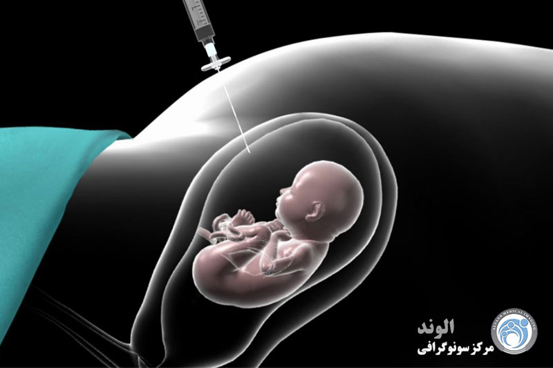 هزینه آزمایش آمنیوسنتز