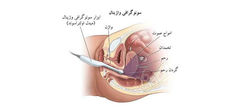 سونوگرافی واژینال در تهران Vaginal ultrasound in Tehran